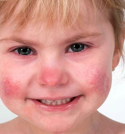 Pigen lider af sygdommen SAVI, fordi cellerne i hendes krop konstant frigiver molekyler, der giver betændelse. Det resulterer i kraftig hudeksem, problemer med lungefunktion og nedsat vækst. Foto: National Institutes of Health